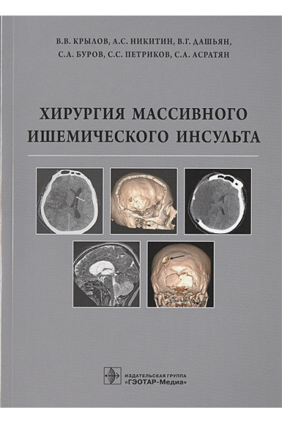 Крылов В., Никитин А., Дашьян В., Буров С. и др: Хирургия массивного ишемического инсульта