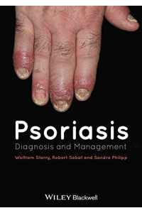 Psoriasis. Diagnosis and Management